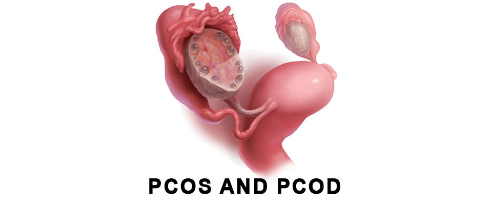 PCOD vs. PCOS in India: Symptoms, Core Differences, and Management